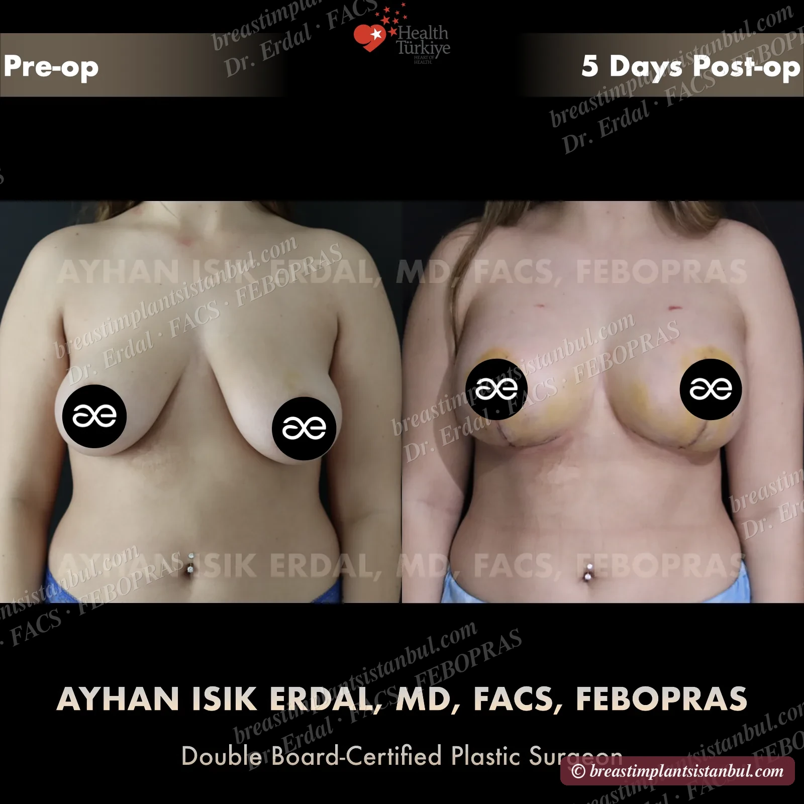 Augmentation + mastopexy case 1, frontal