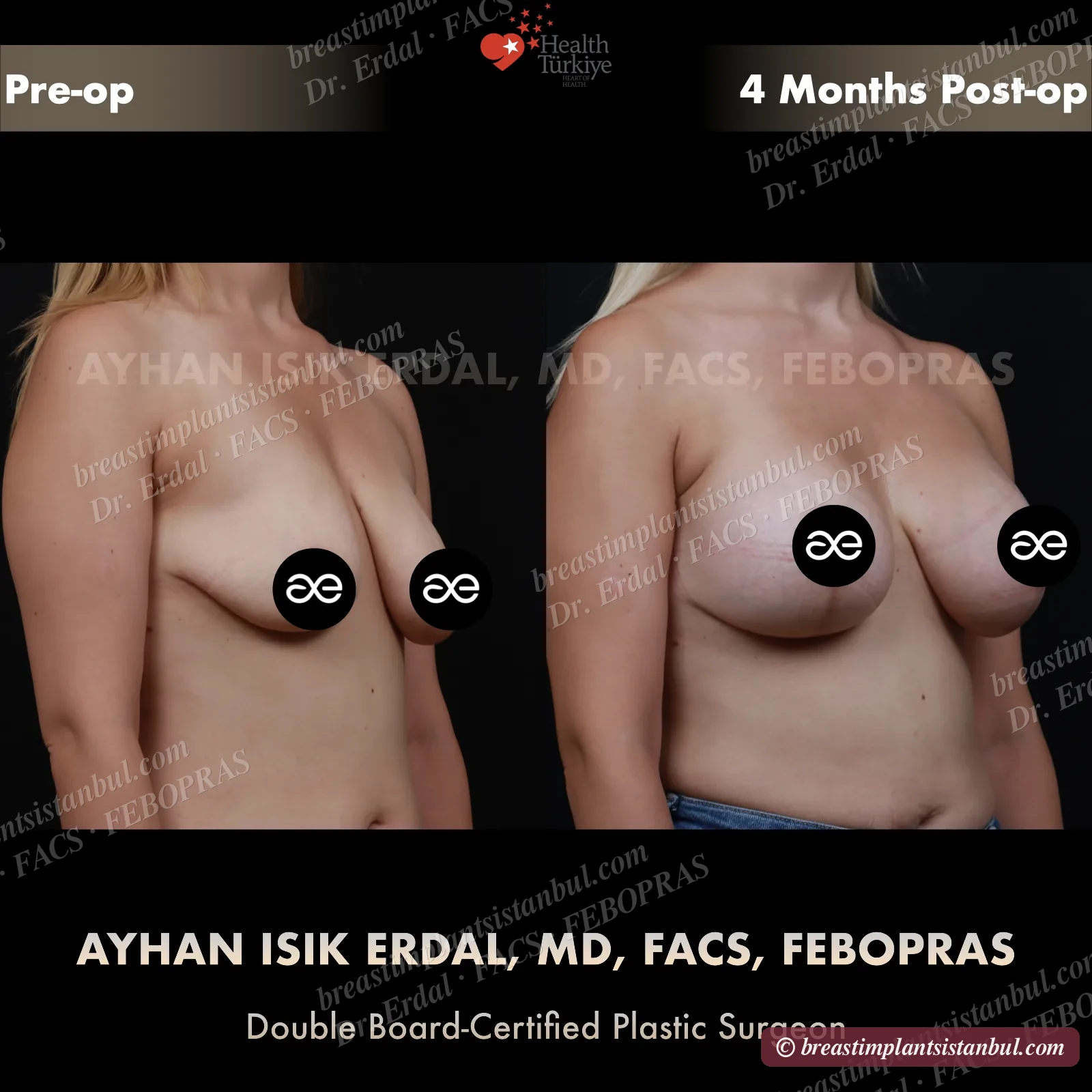 Augmentation + mastopexy case 2, oblique