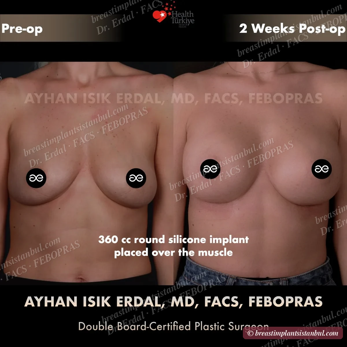 Breast augmentation case 1, frontal view