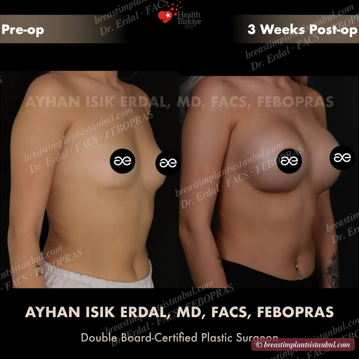 Breast augmentation case 3, oblique view