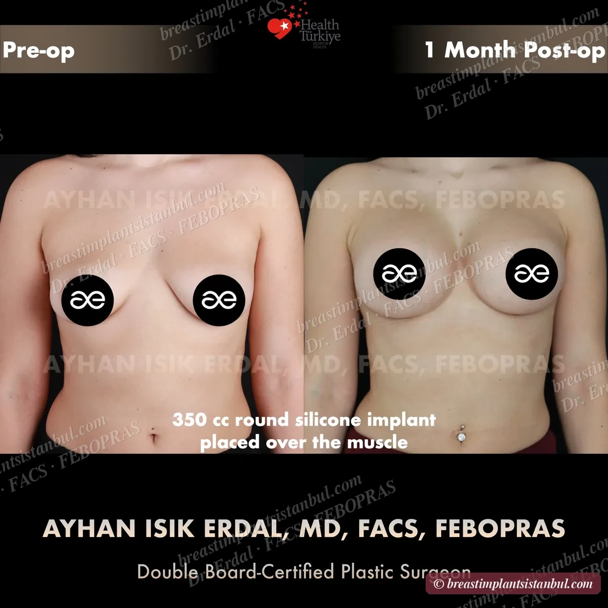 Breast augmentation case 7, frontal view