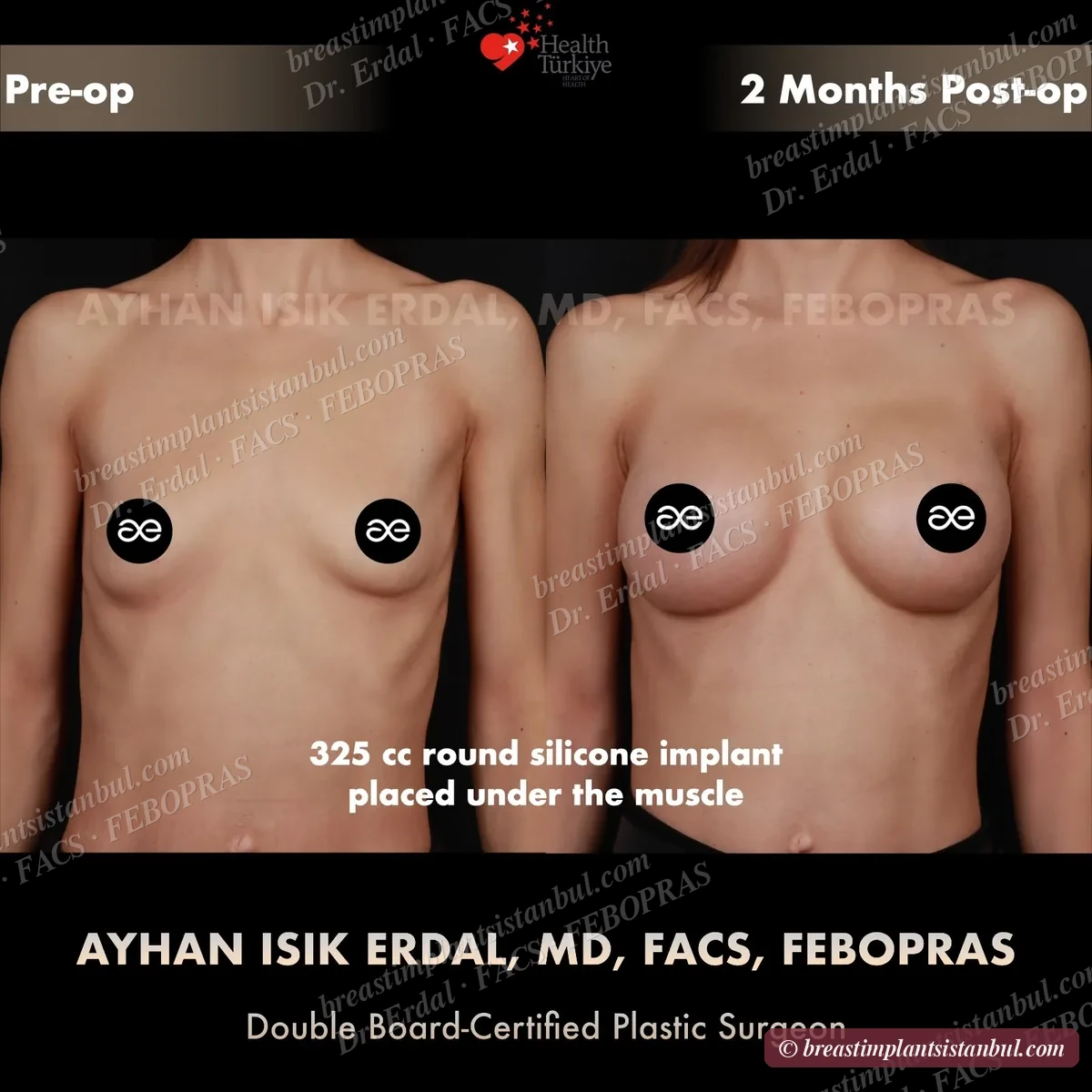 Breast augmentation case 10, frontal view